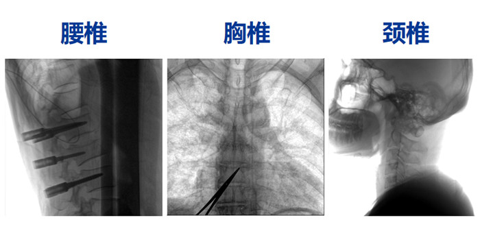 骨科手术机器人能做什么手术