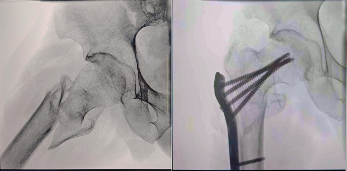 一体式移动C型臂临床影像