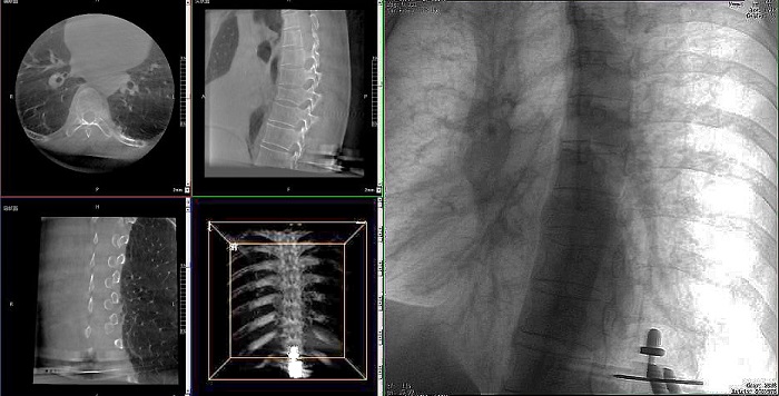 机器人做胸椎手术影像
