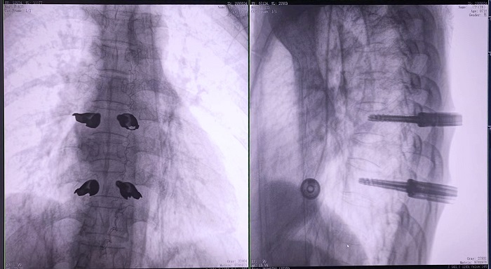 机器人做胸椎置钉手术