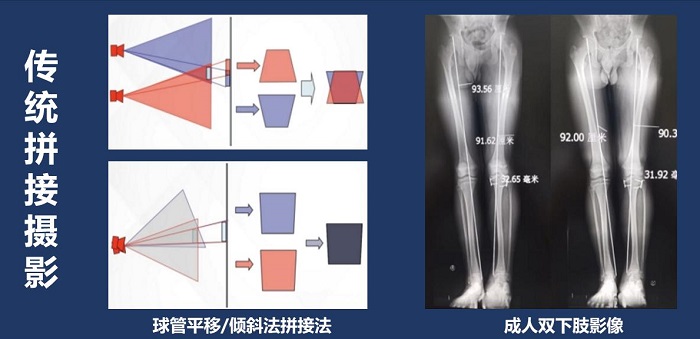 长骨拼接技术拍摄全脊柱X光片